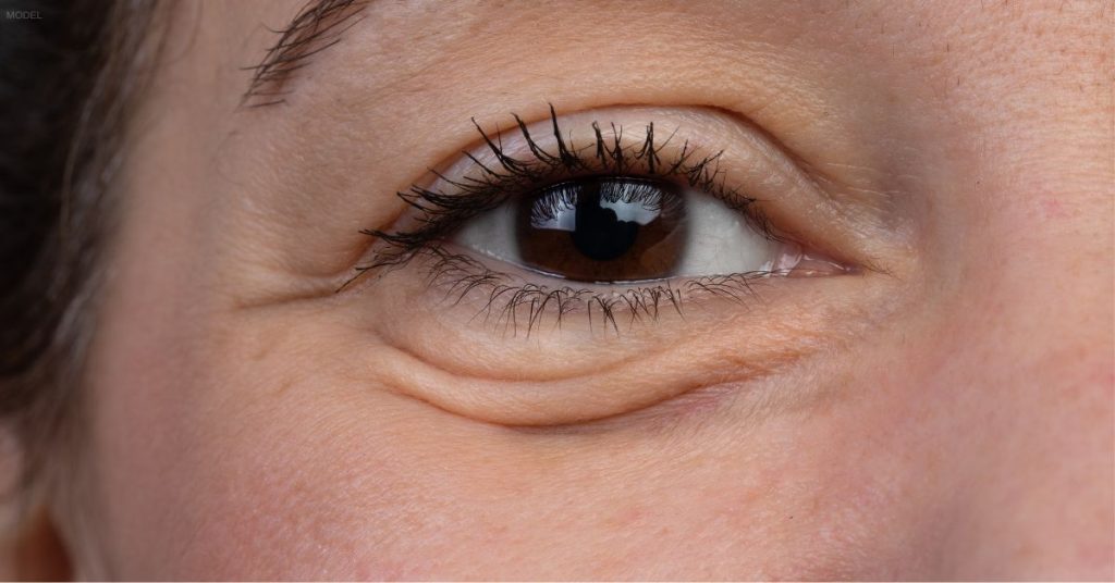 Close up of woman (model) with under-eye wrinkles.
