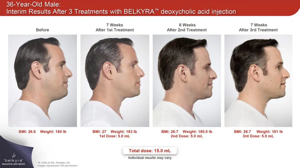 Interim results for a man after 3 treatments with KELKYRA deoxycholic acid injections